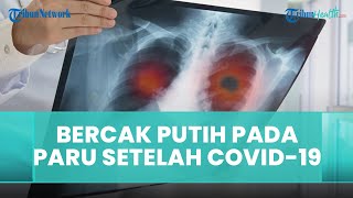 Apa Itu Bercak Putih pada Paru-paru setelah Covid-19?