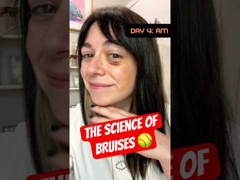 What is a BRUISE? 🥎 watch my black eye heal