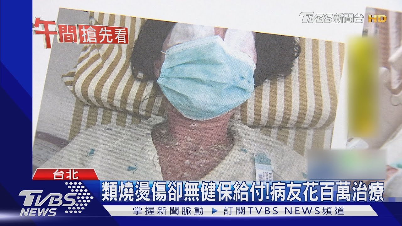 吃藥過敏竟如「燒燙傷」 病友沒指甲、近全盲