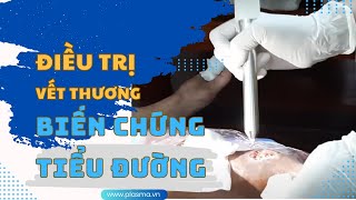 PlasmaMED: Điều trị vết thương tại nhà cho bệnh nhân loét biến chứng tiểu đường