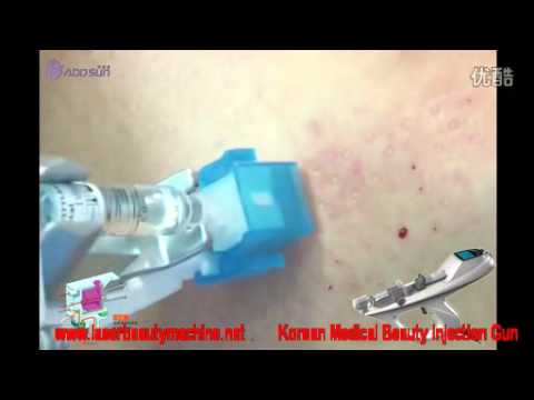 Come distinguere un posto di pigmentary da una lentiggine Eliminazione laser di posti pigmentary di video su facce
