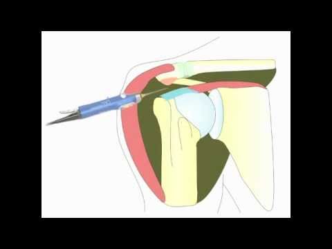 comment traiter une tendinite a l'epaule