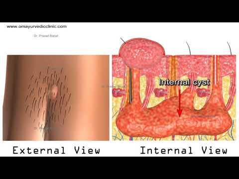 Papilloma vírus megnagyobbodott nyirokcsomók