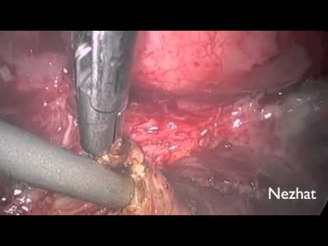 Laparoscopic Shaving of Bowel Endometriosis