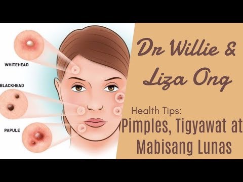 Ekzoderil cured o hindi Laser paggamot ng kuko halamang-singaw Vologda