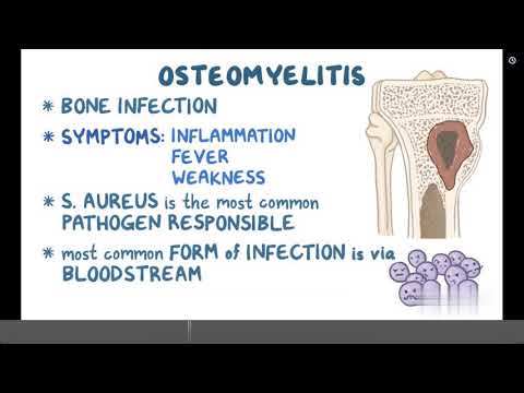 Osteomyelitis - Causes, Symptoms, Diagnosis & Treatment (Pathology)