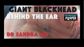 Giant Blackhead, Dilated Pore of Winer, behind the ear extracted