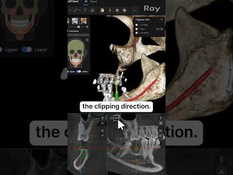 SMARTDent : 5D Tutorial #2-3. Clipping in MPI view