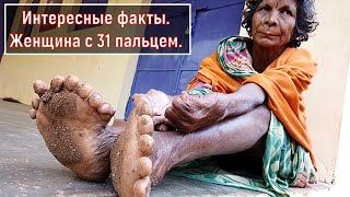 Интересные факты. Женщина с 31 пальцем. Аномалии человеческого тела. 
У Кумари Наяк (Kumari Nayak), жительницы деревени Кадапада (Kadapada) индийского штата Одиша (Odisha), 
имеется 31 палец — 12 на руках и 19 на ногах.
Из-за этого