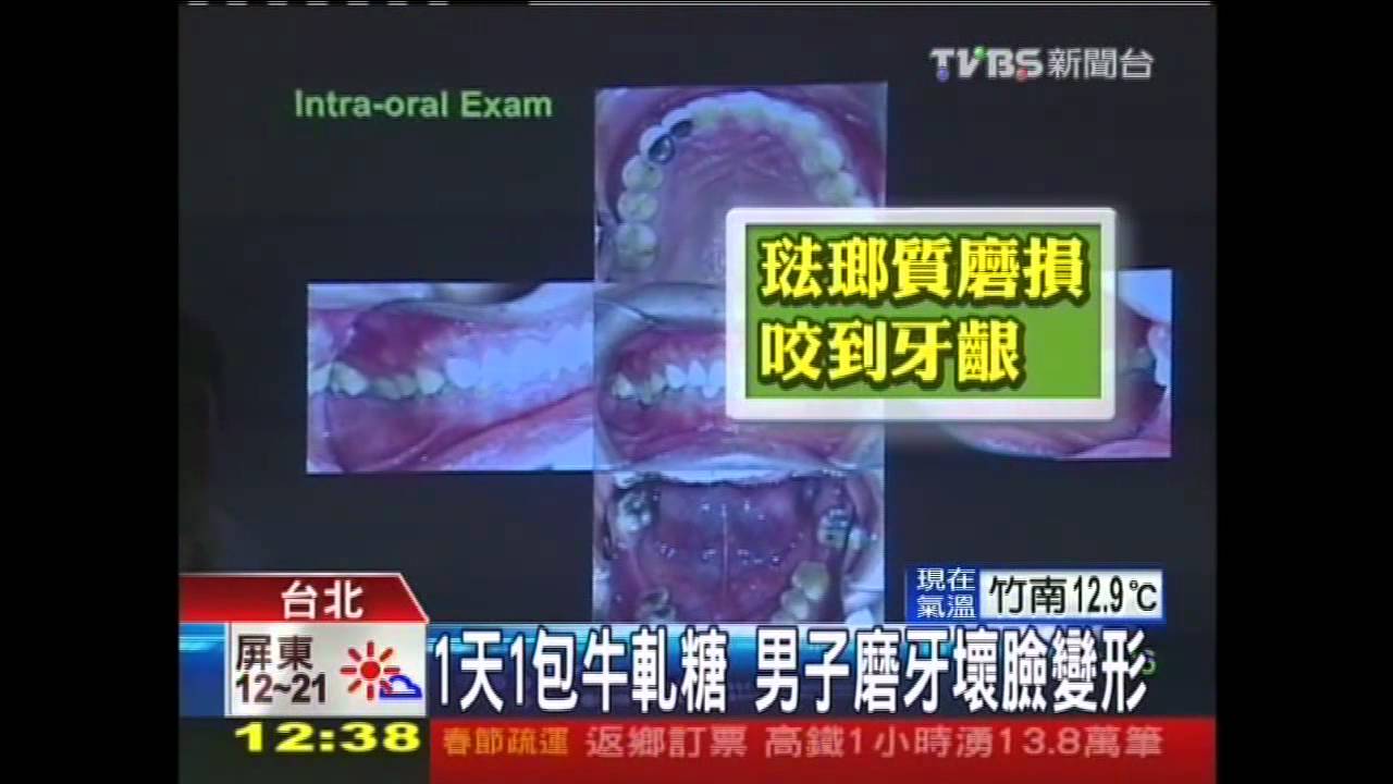 1天1包牛軋糖 男子磨牙壞臉變形