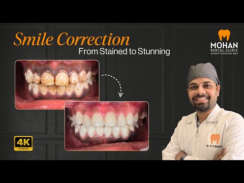 Smile Correction : From Stained to Stunning Smile #mohandentalclinic #beforeandafter #smiledesigning