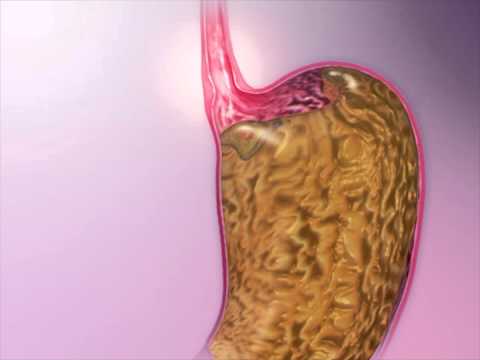 GERD: Learn@Visible Body