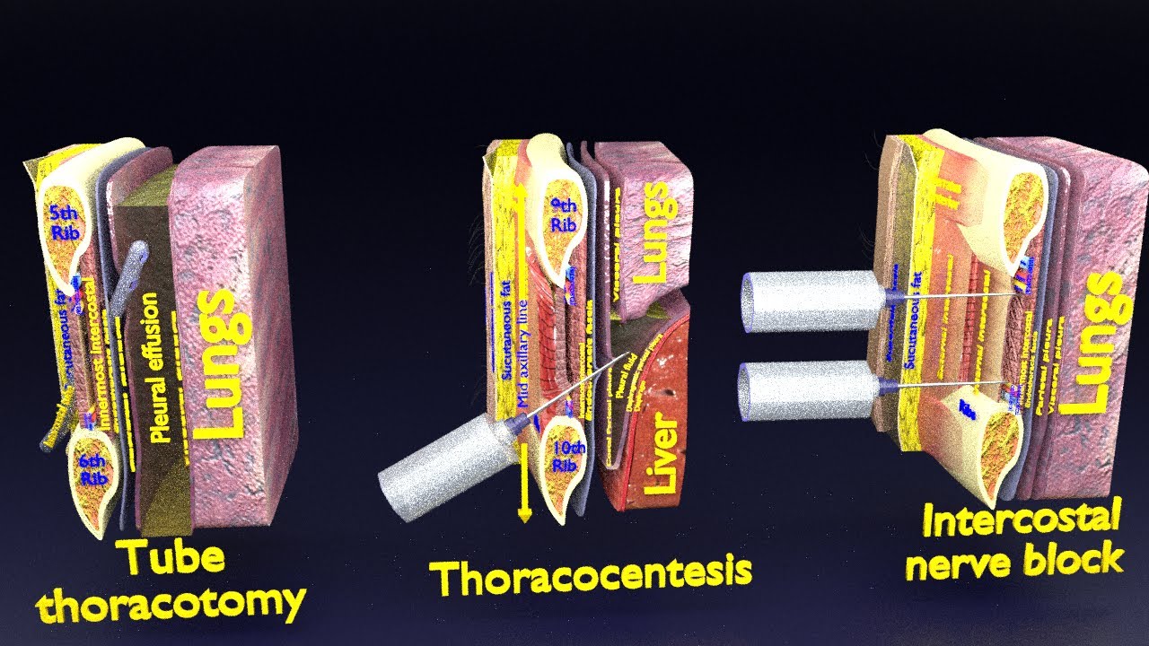 3D thoracic procedures 3D Model