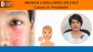 BROKEN CAPILLARIES on FACE! |Skin REDNESS | BLOOD VESSELS on face - Dr.Rasya Dixit | Doctors