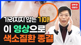 Eng)기미 주근깨 없애는 법! 피부과 전문의가 추천하는 색소질환 완벽하게 제거하는 시술은?