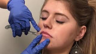 How Does Lip Filler Work with a Naturally Thin Lip? Nashville Injector