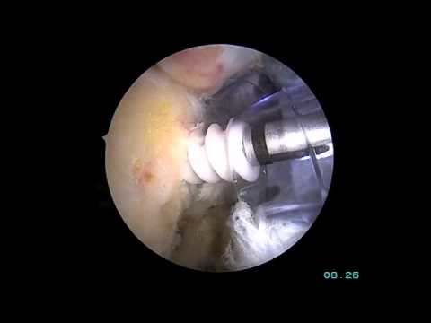 Réparation sous-scapulaire arthroscopique
