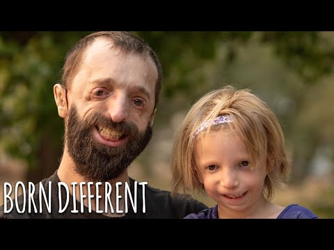 Father And Daughter Battle Rare Facial Condition | BORN DIFFERENT
