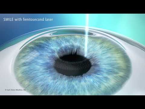 Treatment with SMILE  Animation