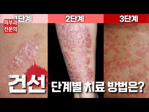 건선 어떻게 치료할까? 건선 증상 단계별 치료방법 알려드립니다!