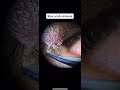 Stye Scab Removal