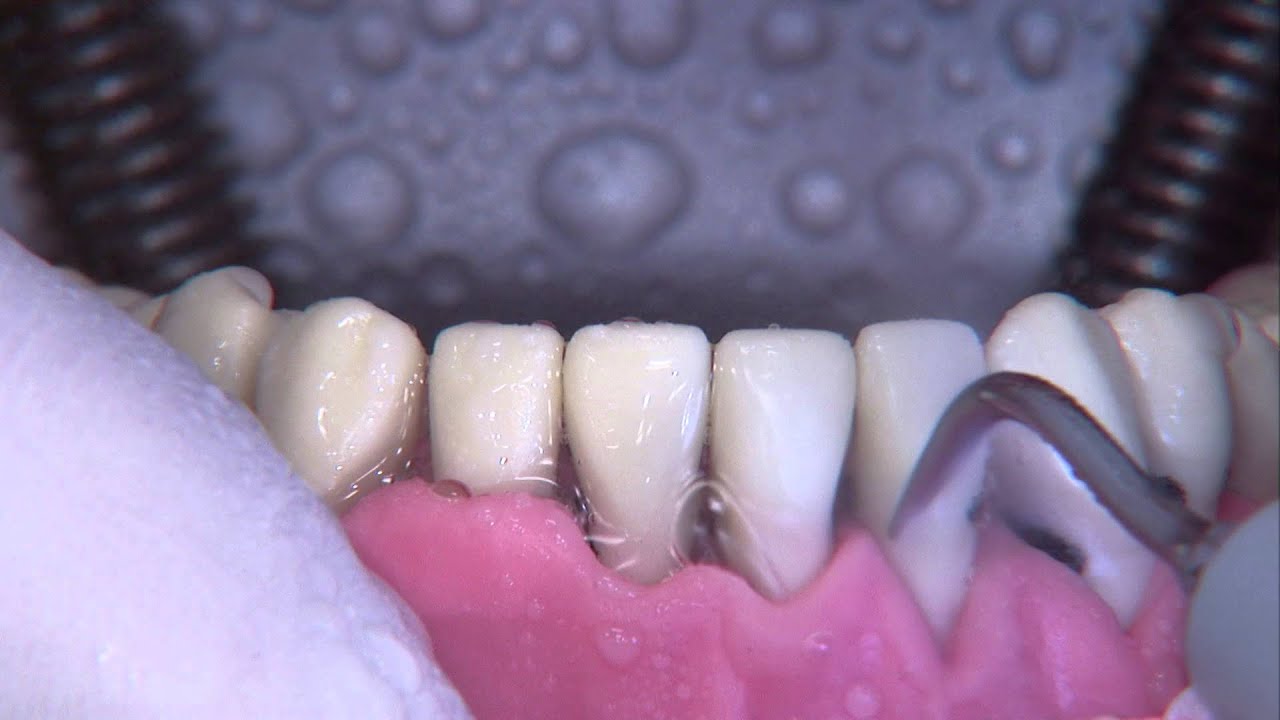 Détartrage dentaire