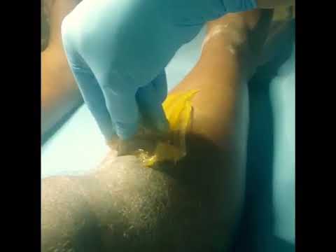 Half leg sugaring