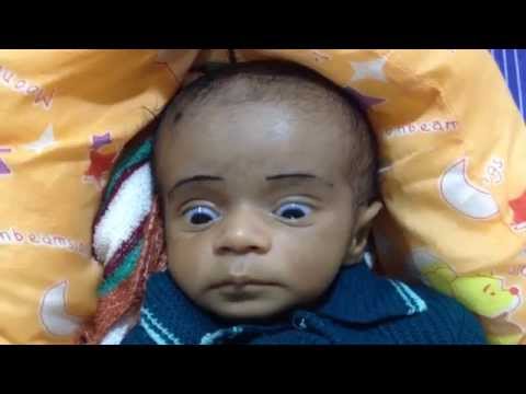 A sequel of Bacterial meningitis