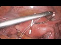 Laparoscopic Removal Of A Perforated Intrauterine Device By Dr R K Mishra