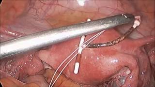 Laparoscopic Removal of a Perforated Intrauterine Device by Dr. R.K. Mishra
