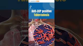 Download lagu Anti-CCP antibodies (Anti-citrullinated peptide antibodies ) test - what does it mean? mp3 Download lagu Anti-CCP antibodies (Anti-citrullinated peptide antibodies ) test - what does it mean? mp3