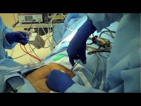 Laparoscopic use of Palmer's Point