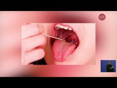 Preocupación por la angina bacteriana