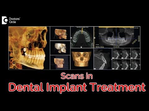 Role of CBCT scans in Dental Implant Treatment