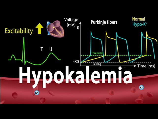 Vidéo Prononciation de hypokalemia en Anglais