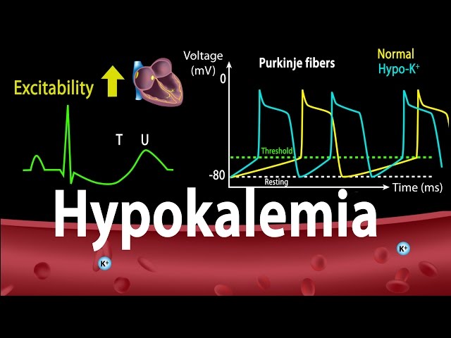 Pronunție video a hypokalemia în Engleză