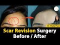 Scar Revision Surgery Before and After "Spark Clinique"  #scarrevision #plasticsurgeon