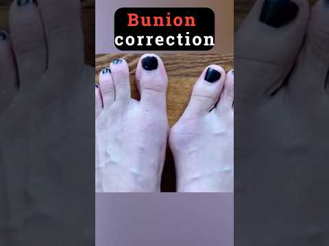 Bunion Correction Exercise – Fix Your Big Toe Naturally
