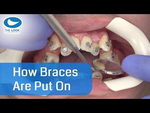 How braces are put on - AMAZING ! - Now with 12 month - Progress : 