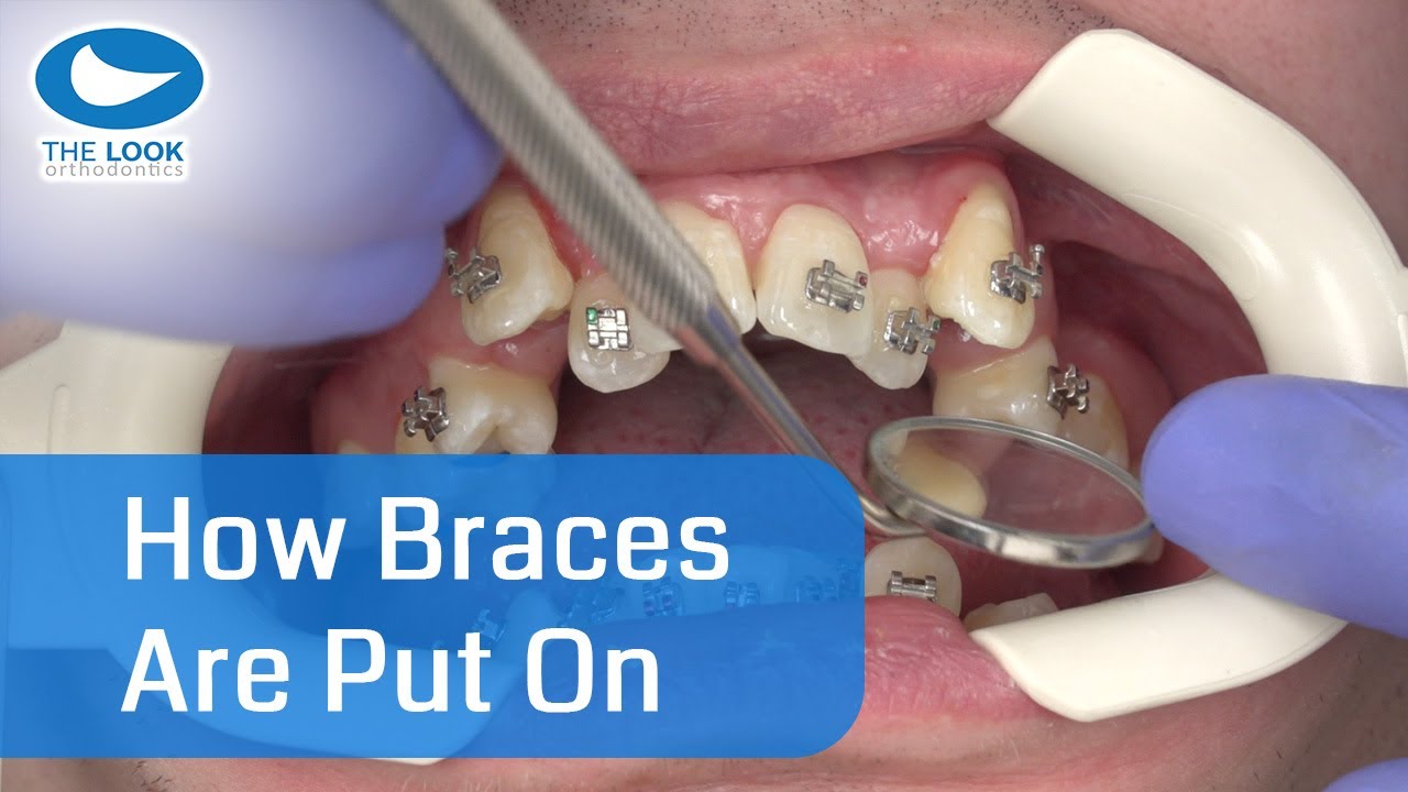 How braces are put on - AMAZING ! - Now with 12 month - Progress : https://goo.gl/jXaY15