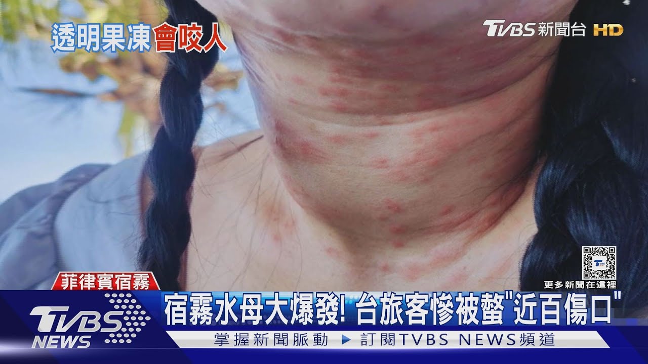 宿霧水母大爆發! 台旅客慘被螫「近百傷口」