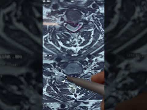 Posterior cervical laminectomy? - Dr. Ajay Kothari