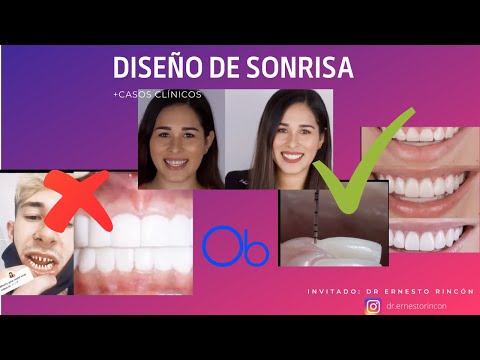 ¿Qué es un DISEÑO DE SONRISA?