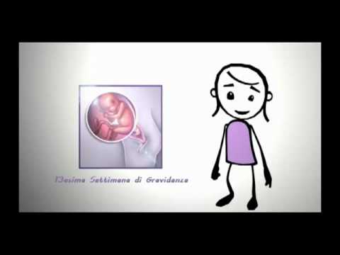 Lombalgia nelle donne dolorose a camminare Frattura del collo chirurgico dellarticolazione della spalla