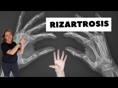 RIZARTROSIS