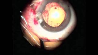 Phaco conversion to MSICS