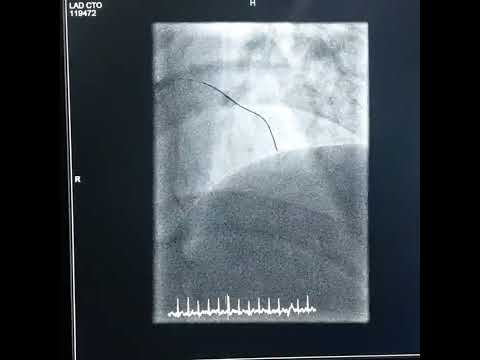 Difficult LAD CTO (J-CTO Score 4)
