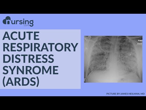 ARDS (Nursing School Lessons)