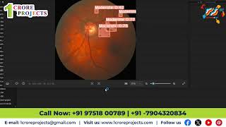 Precision Eye Care Employing YOLO V7 for the Detection of Optical Glaucoma via Python