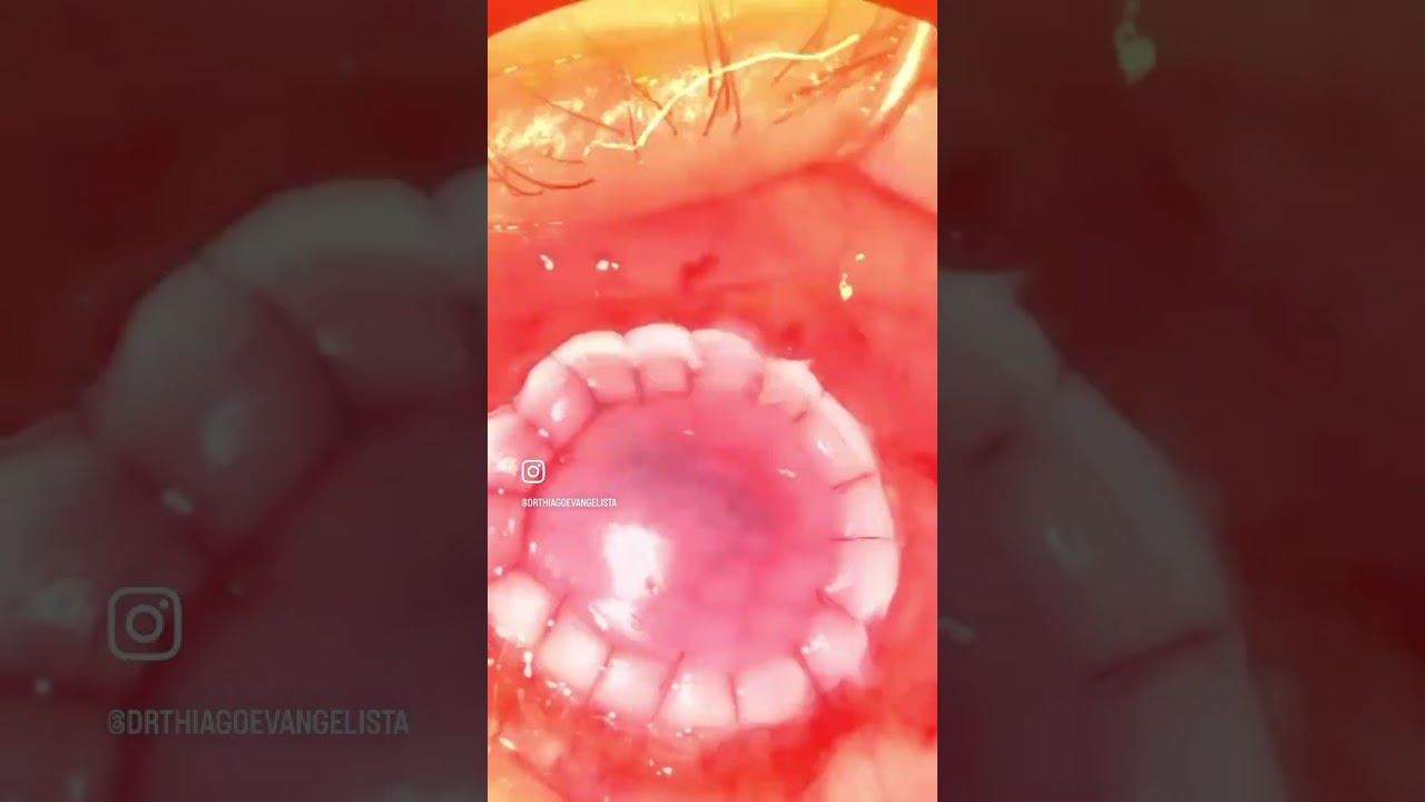 Cirurgia de transplante de córnea